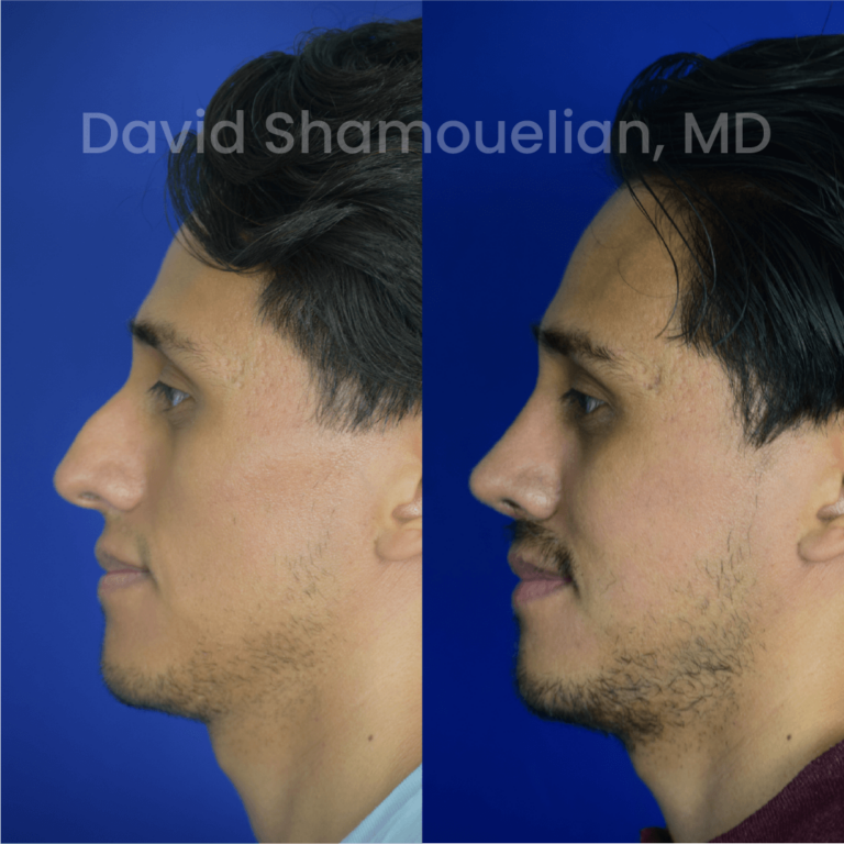 allure-bh-before-after-rhino-pt-33-03