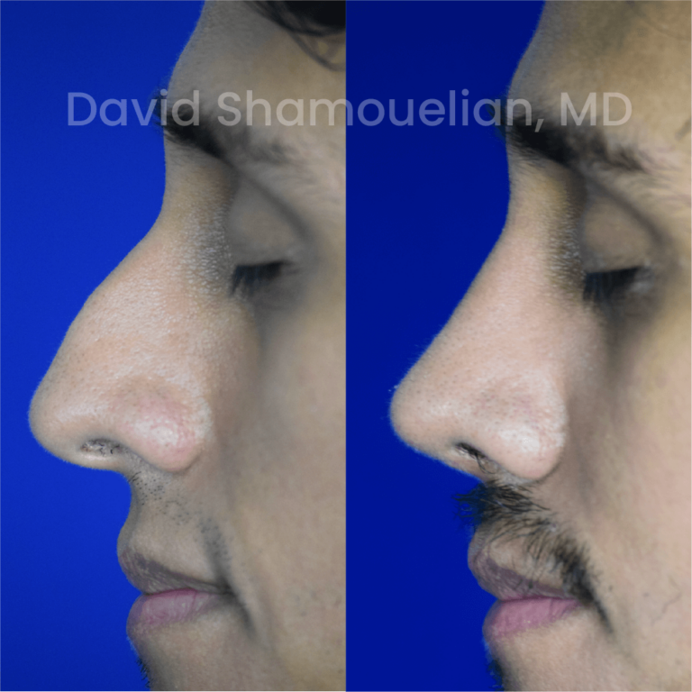 allure-bh-before-after-rhino-pt-33-04