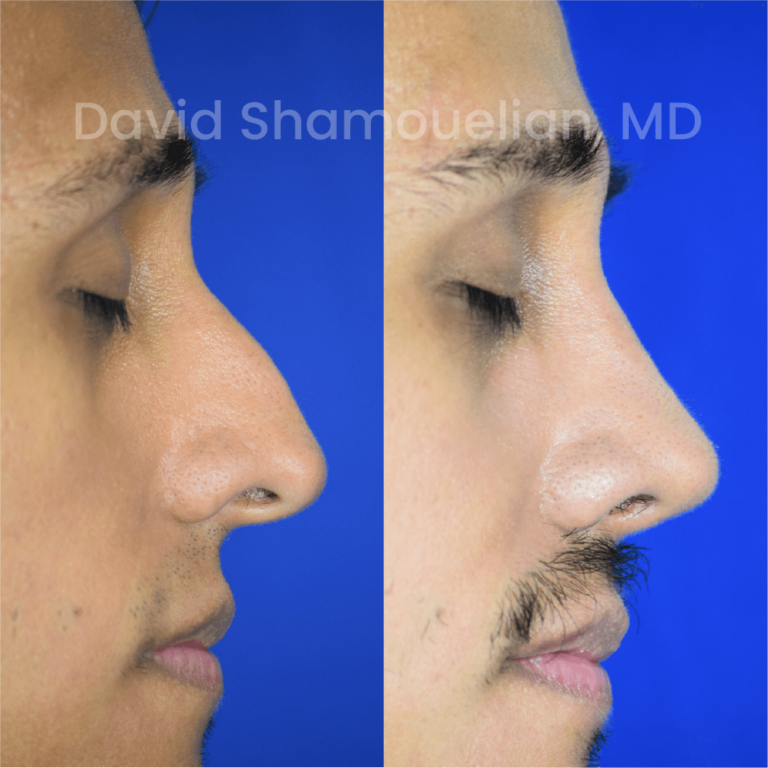allure-bh-before-after-rhino-pt-33-05