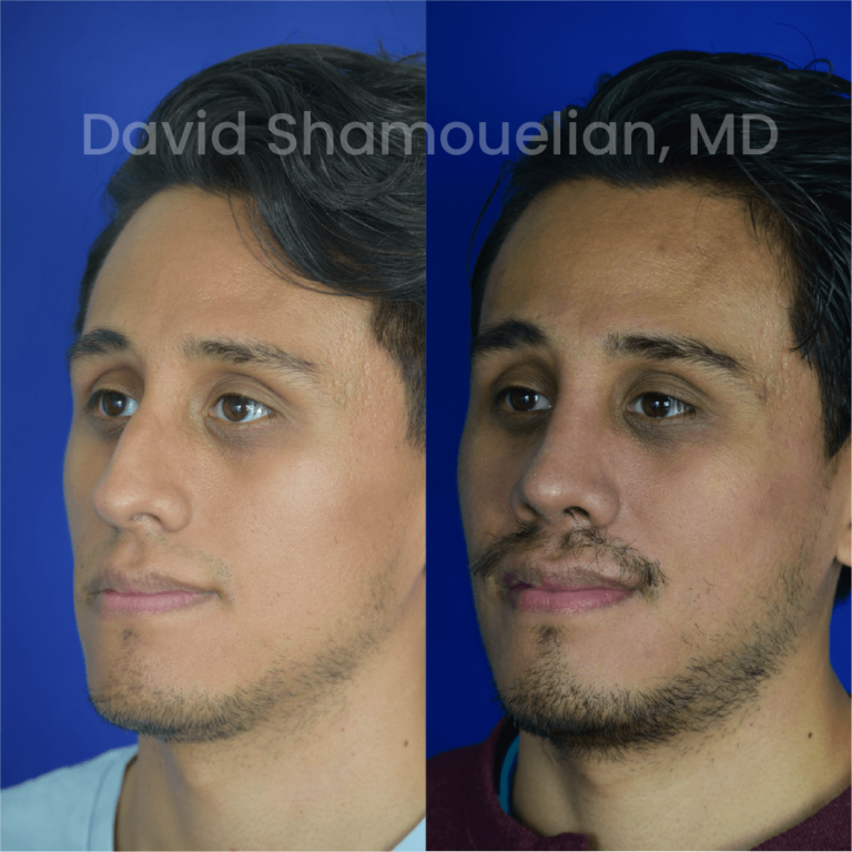 allure-bh-before-after-rhino-pt-33-06