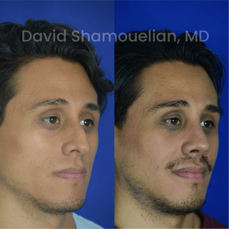 allure-bh-before-after-rhino-pt-33-07