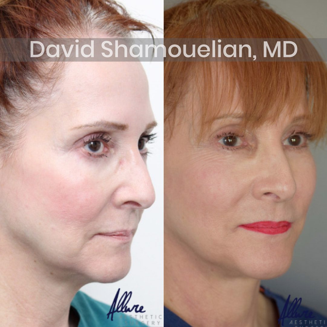 allure-bh-face-and-neck-lift-1-before-after-3