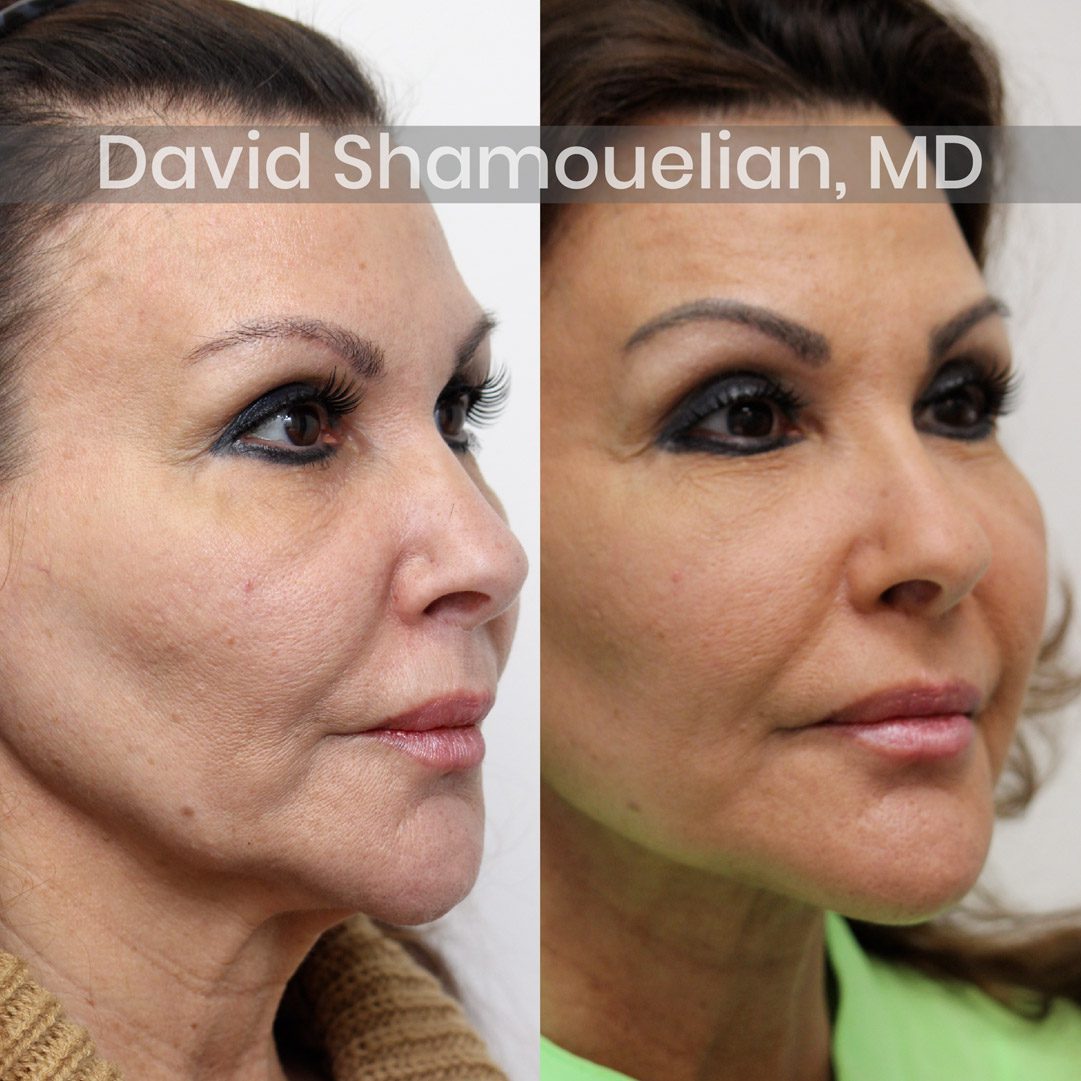 allure-bh-face-and-neck-lift-before-after-2