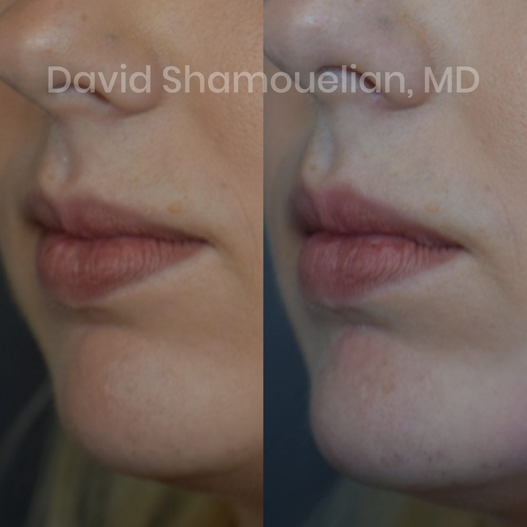 allure-bh-non-surgical-chin-augmentation-before-after-1