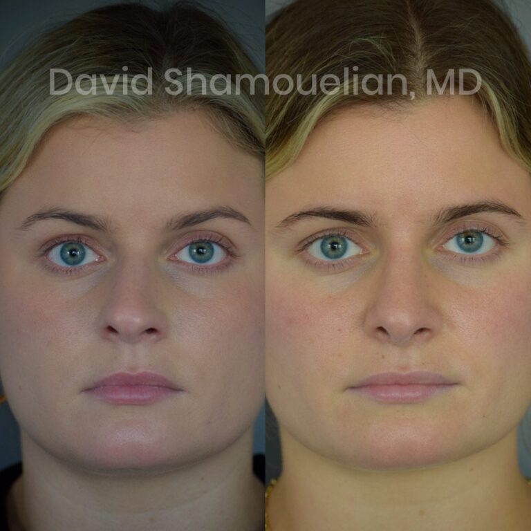 allure-bh-rhinoplasty-1-before-after-1