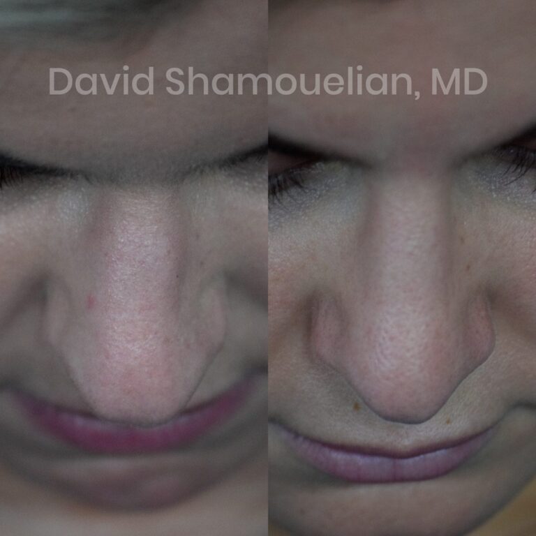 allure-bh-rhinoplasty-1-before-after-10