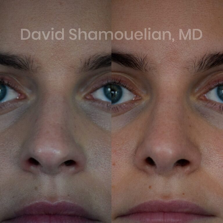 allure-bh-rhinoplasty-1-before-after-2