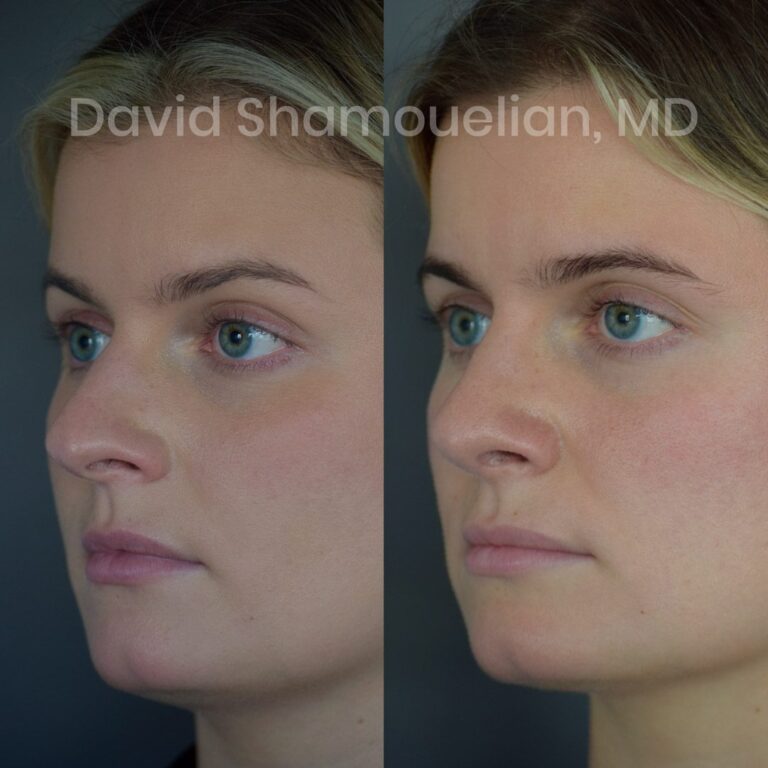 allure-bh-rhinoplasty-1-before-after-3