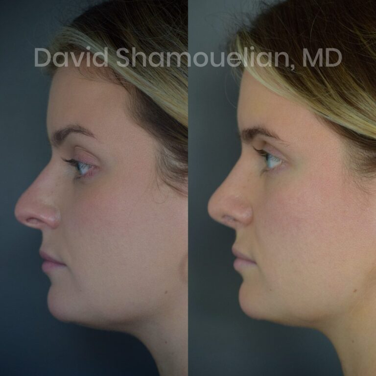 allure-bh-rhinoplasty-1-before-after-4