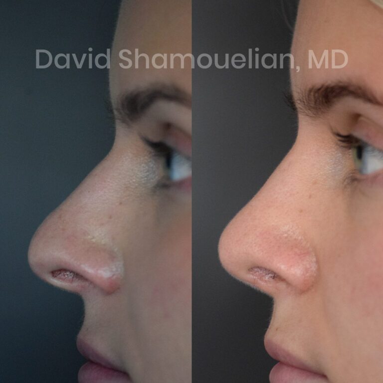 allure-bh-rhinoplasty-1-before-after-5