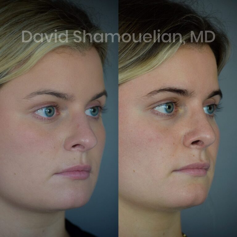 allure-bh-rhinoplasty-1-before-after-6