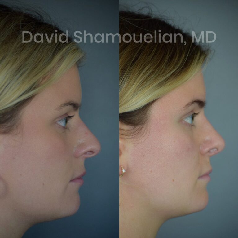 allure-bh-rhinoplasty-1-before-after-7