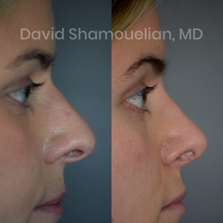 allure-bh-rhinoplasty-1-before-after-8