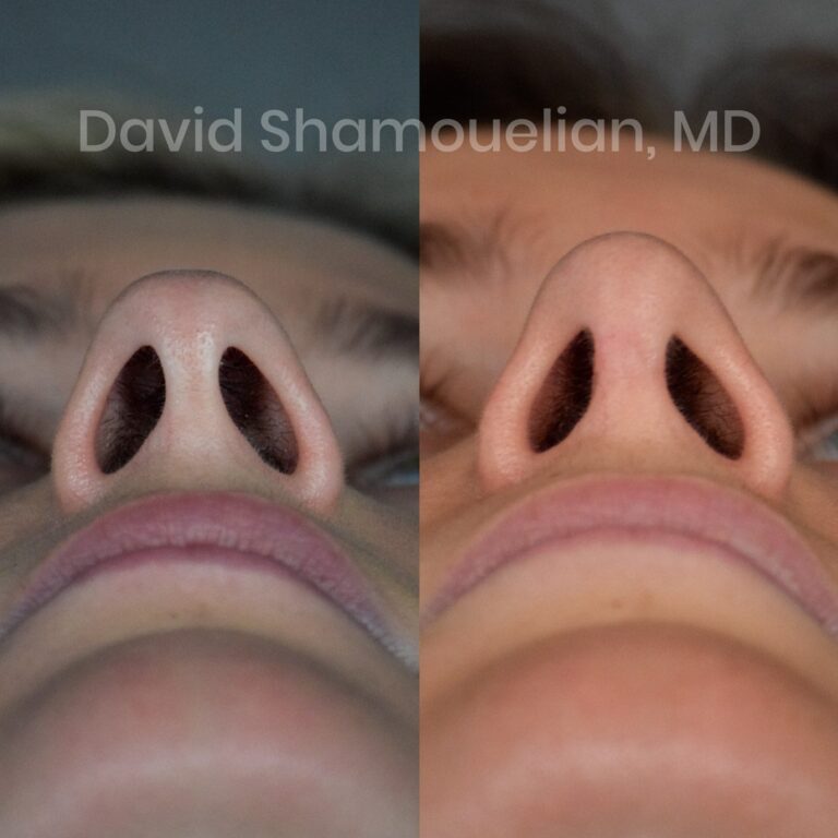 allure-bh-rhinoplasty-1-before-after-9