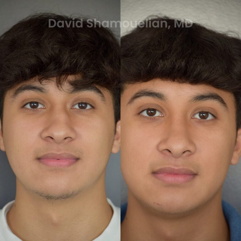 allure-bh-rhinoplasty-25-before-after-1
