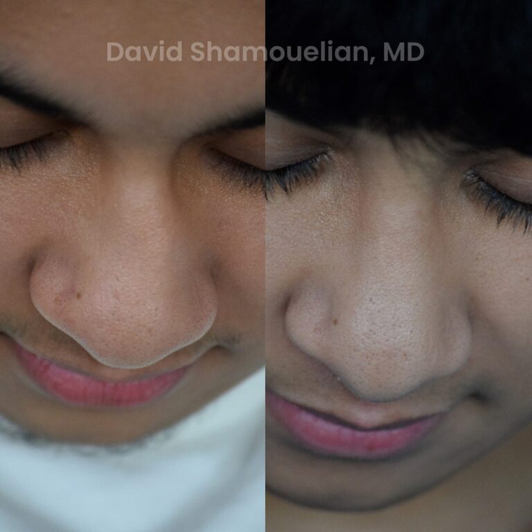 allure-bh-rhinoplasty-25-before-after-10
