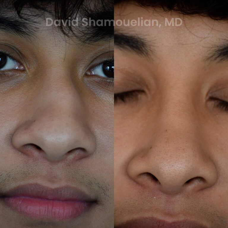 allure-bh-rhinoplasty-25-before-after-2