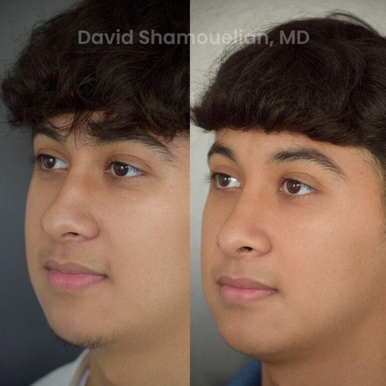 allure-bh-rhinoplasty-25-before-after-3