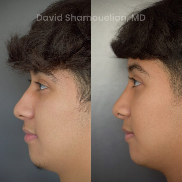 allure-bh-rhinoplasty-25-before-after-4