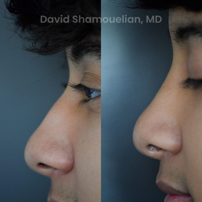 allure-bh-rhinoplasty-25-before-after-5