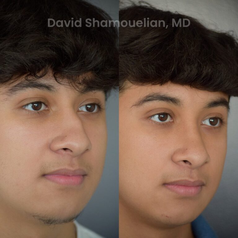 allure-bh-rhinoplasty-25-before-after-6