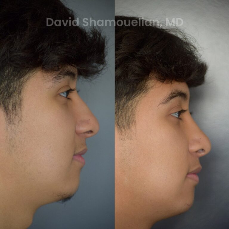 allure-bh-rhinoplasty-25-before-after-7