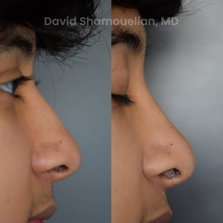 allure-bh-rhinoplasty-25-before-after-8