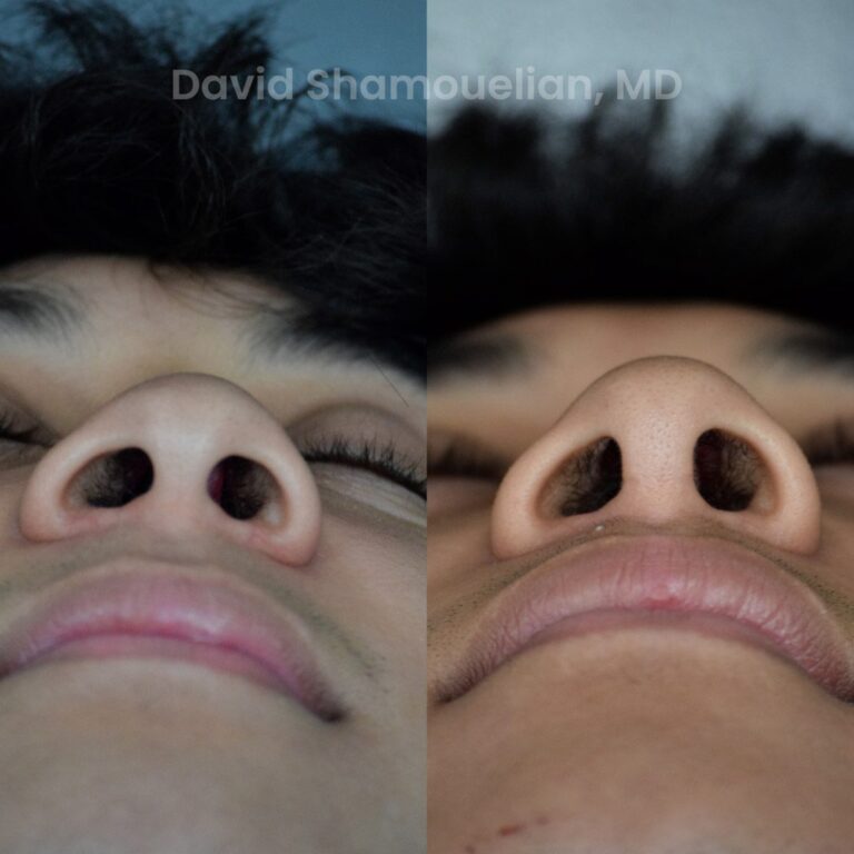 allure-bh-rhinoplasty-25-before-after-9
