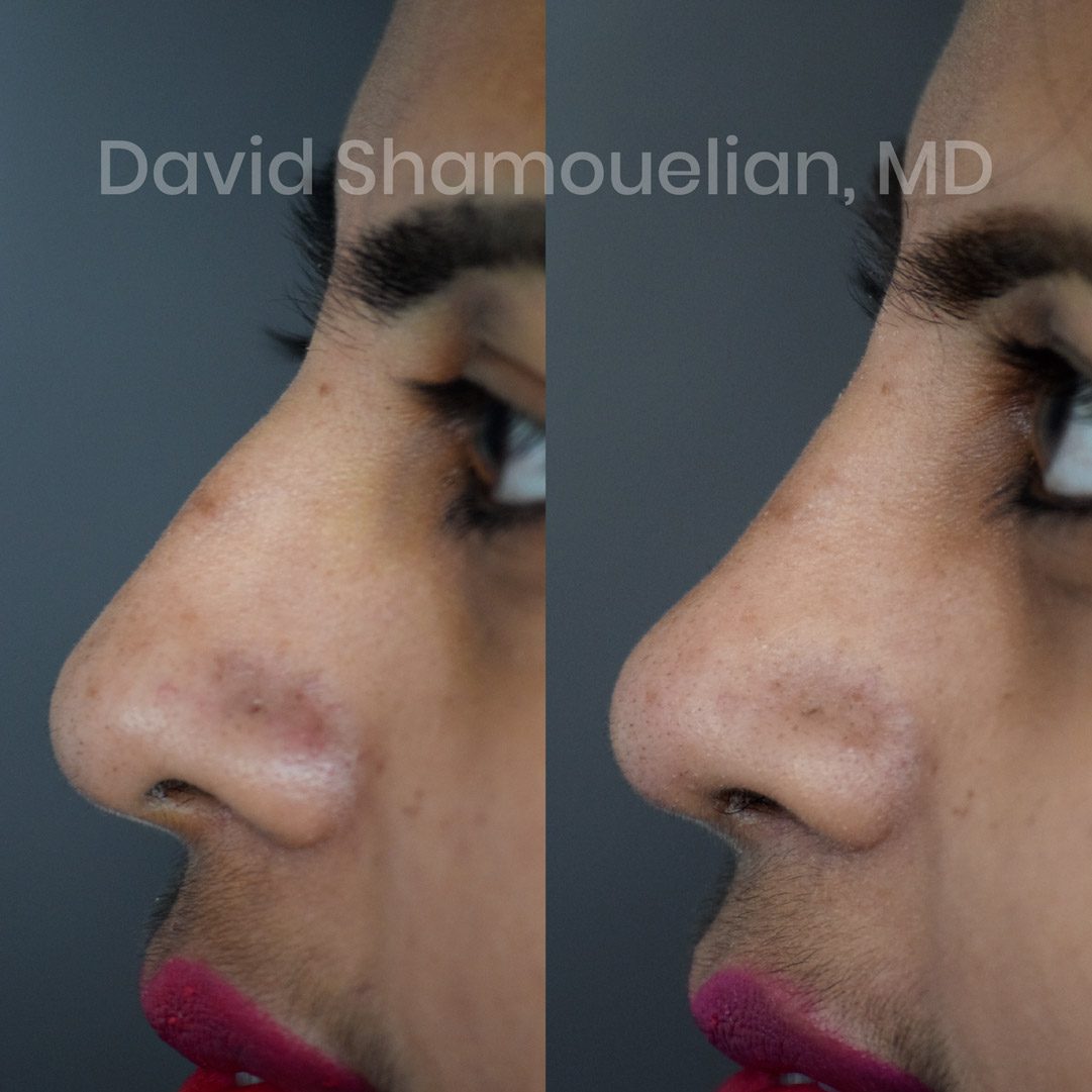 allure-bh-rhinoplasty-before-after-4