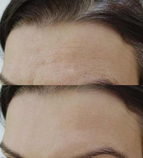 before-after-results-of-endoscopic-forehead-lift