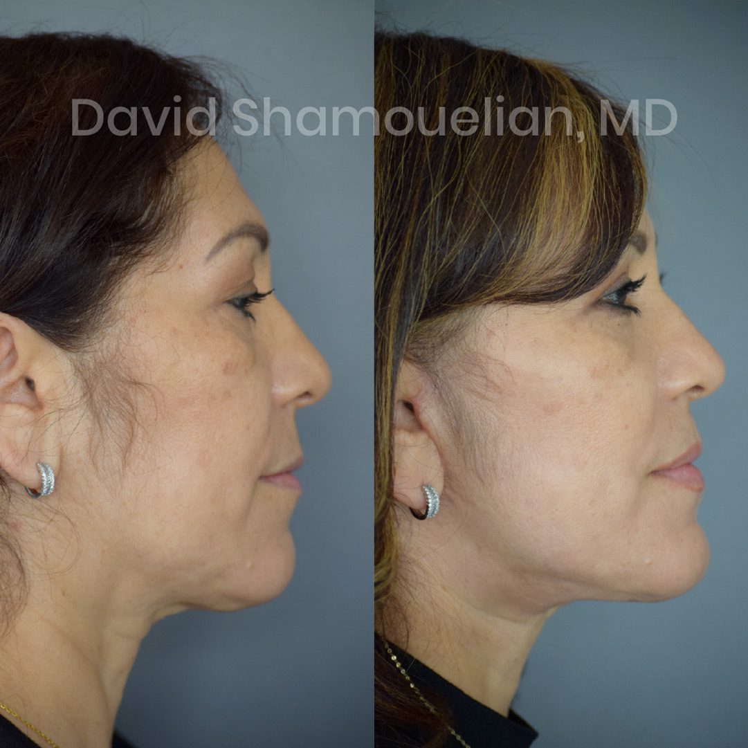 face-and-neck-lift-2-before-and-after-3