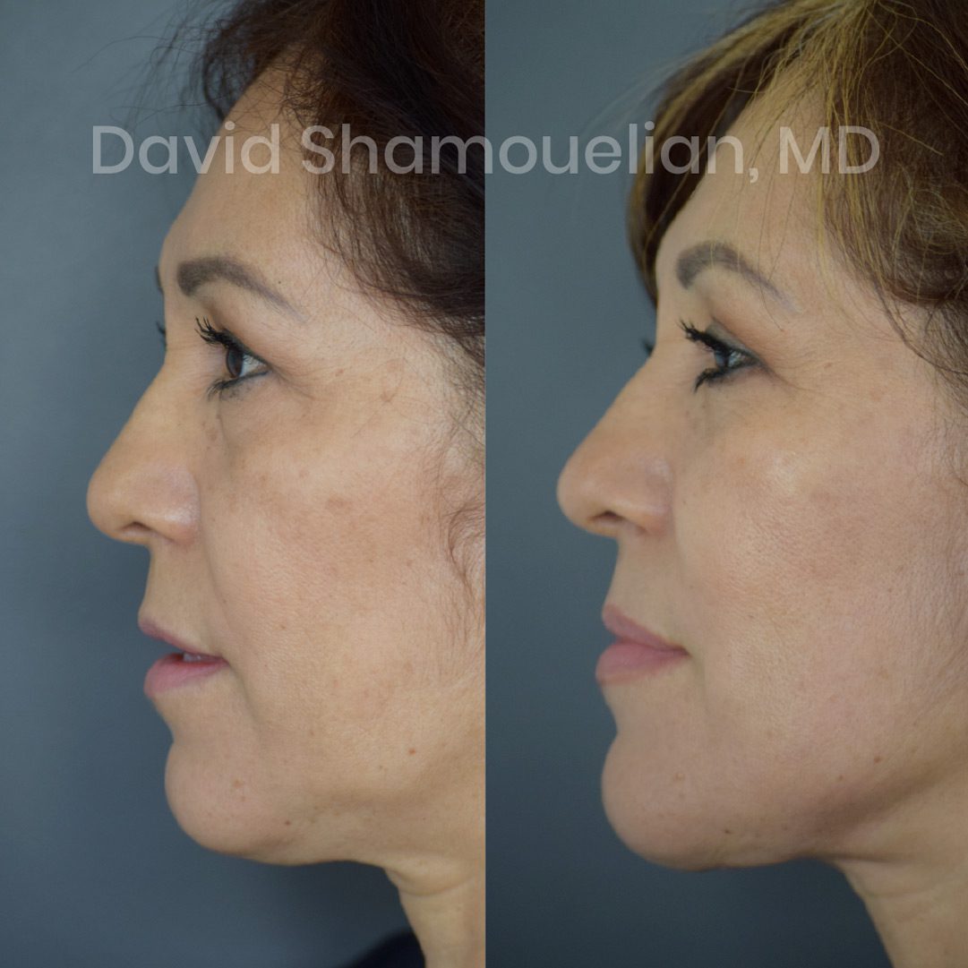 face-and-neck-lift-2-before-and-after-5