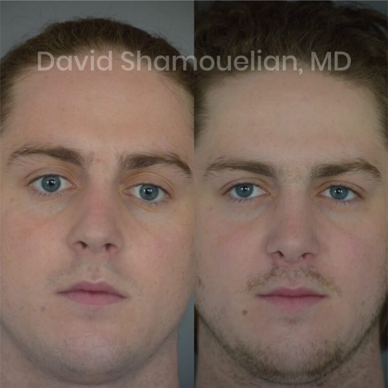 patient-6-before-after-1-1