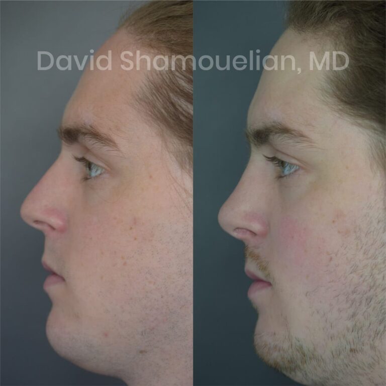 patient-6-before-after-3-1