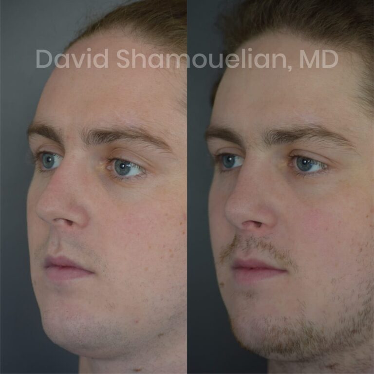patient-6-before-after-4-1
