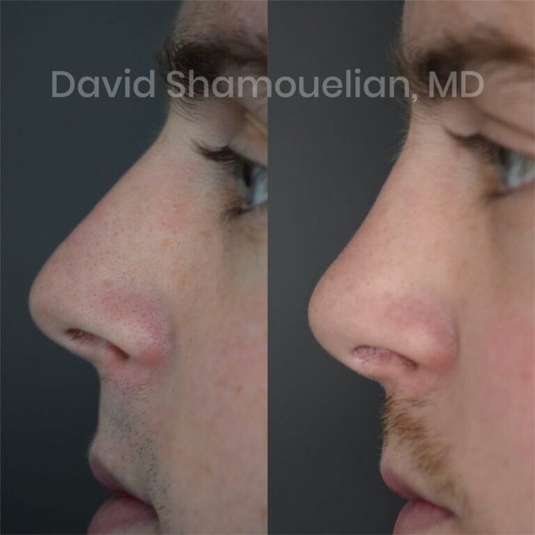 patient-6-before-after-5-1