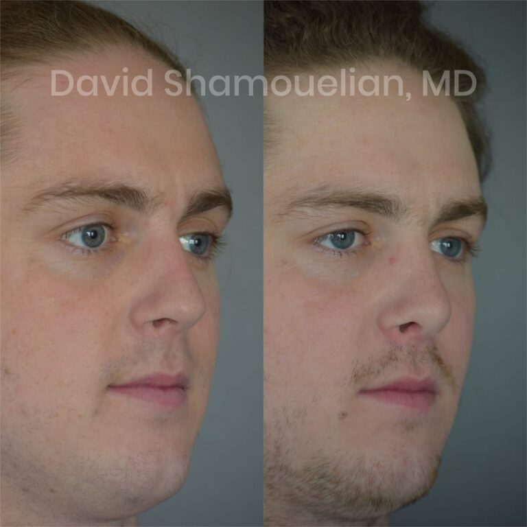 patient-6-before-after-6-1
