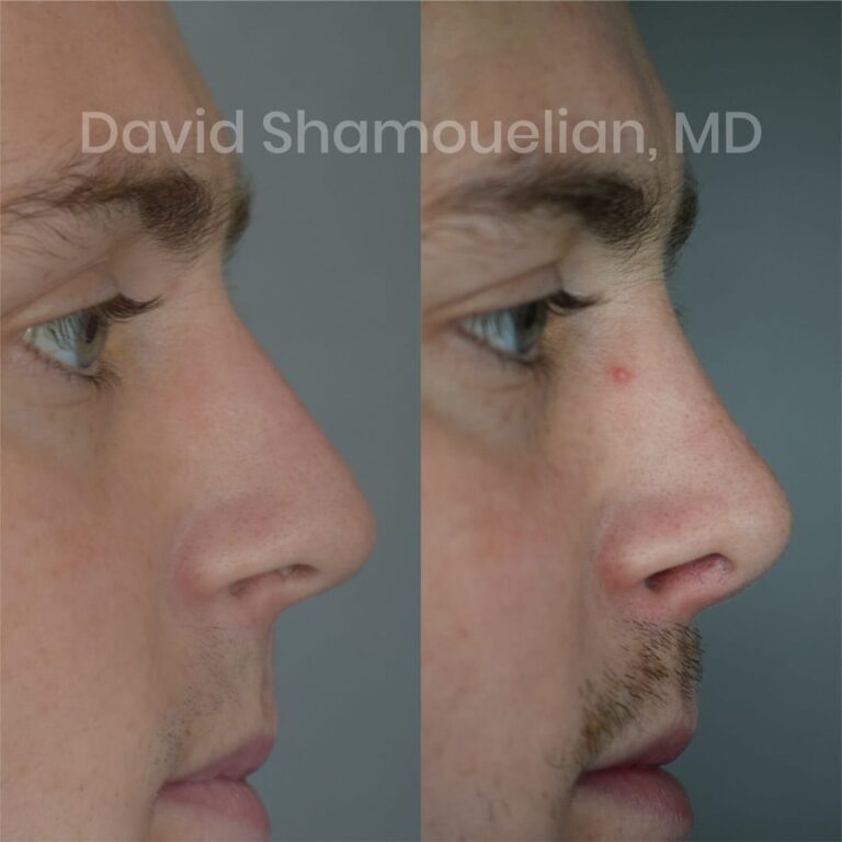 patient-6-before-after-7-1