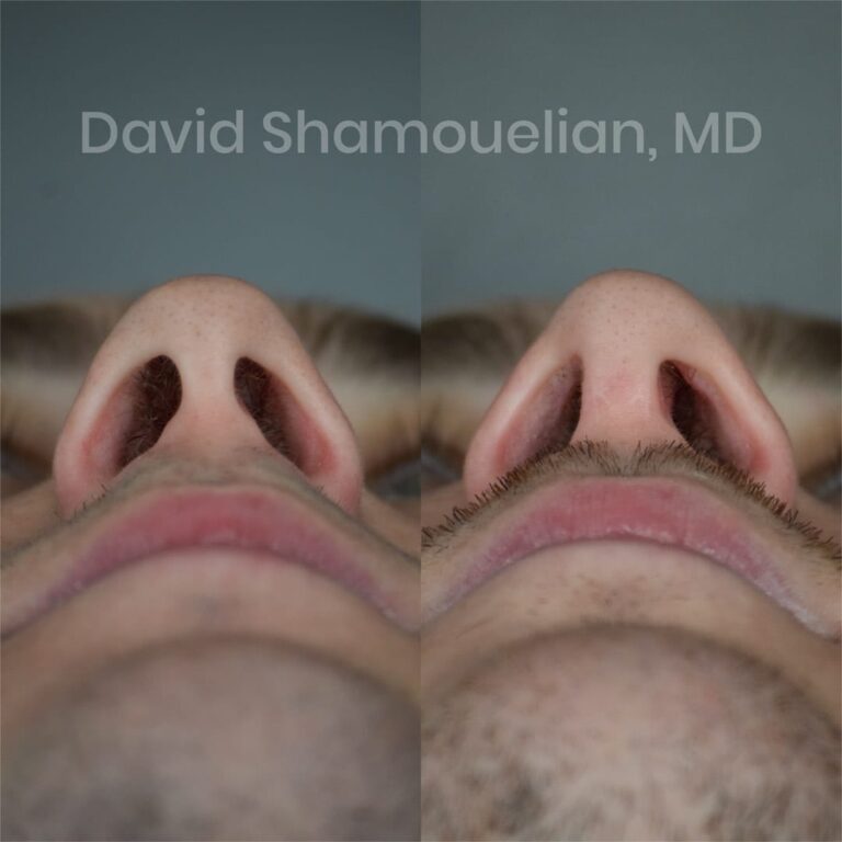 patient-6-before-after-8-1