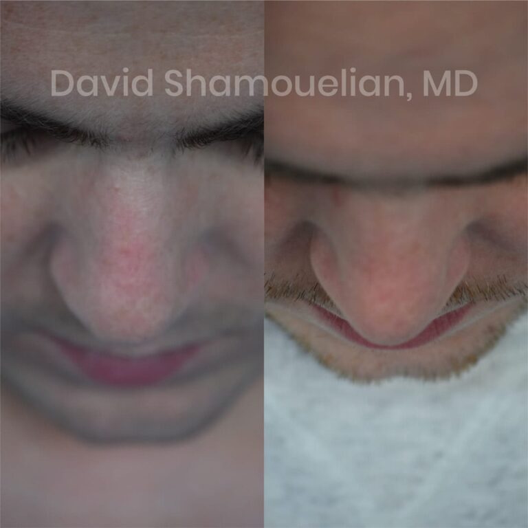 patient-6-before-after-9