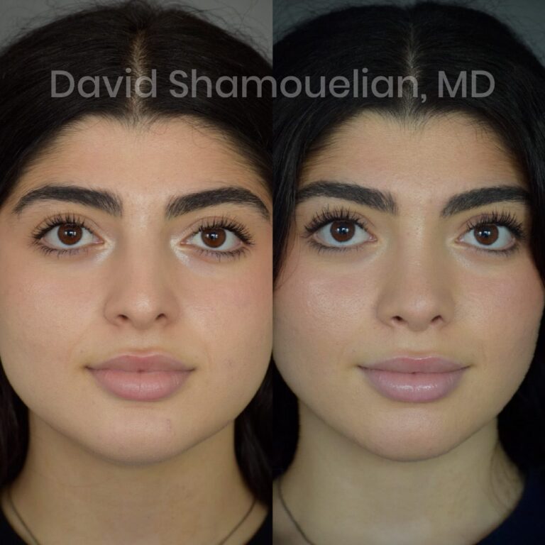 rhinoplasty-before-after-patient-23-1