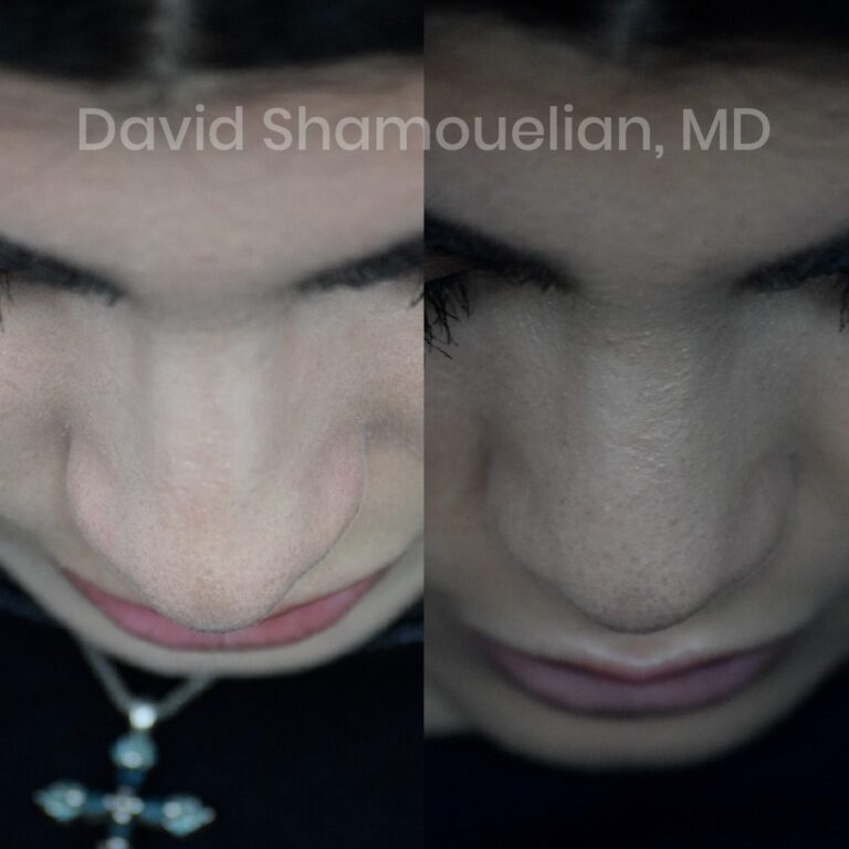 rhinoplasty-before-after-patient-23-10