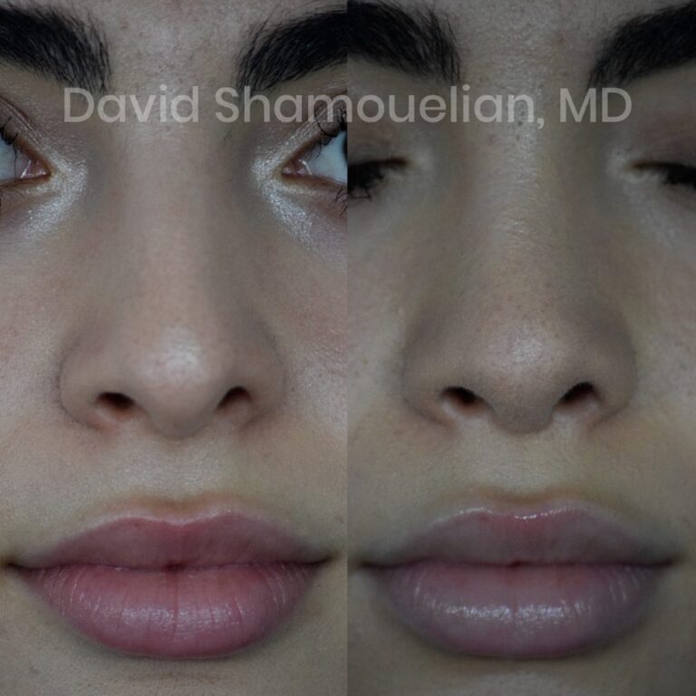 rhinoplasty-before-after-patient-23-2