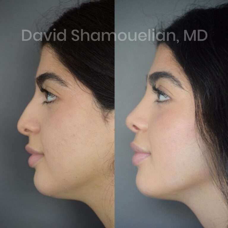 rhinoplasty-before-after-patient-23-3