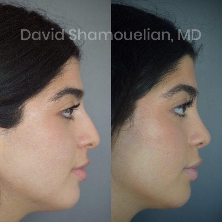 rhinoplasty-before-after-patient-23-4
