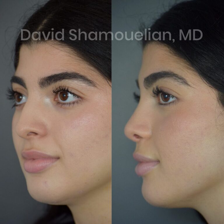 rhinoplasty-before-after-patient-23-5