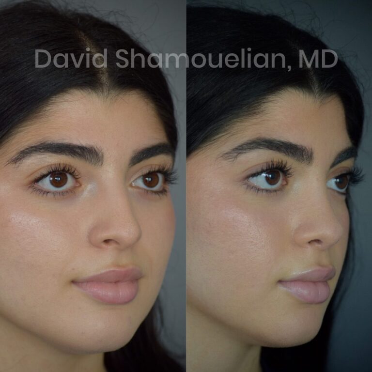 rhinoplasty-before-after-patient-23-6
