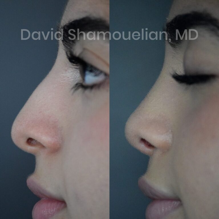 rhinoplasty-before-after-patient-23-7