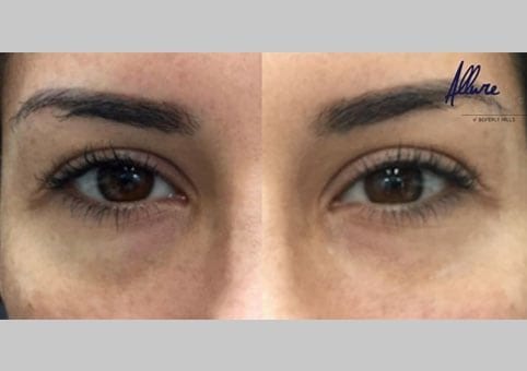 under-eye-rejuvenation-allure-bh3-482x340