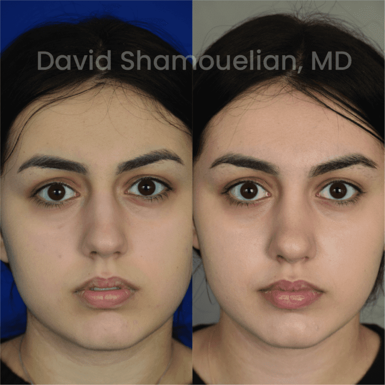Allure BH Before After Rhino Pt 39